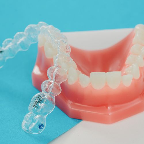 Ein durchsichtiger Aligner wird auf ein rosa-weißes Zahnmodell vor einem blau-weißen Hintergrund gesetzt. Der Aligner erscheint transparent und ist so konzipiert, dass er über das Zahnmodell für die kieferorthopädische Behandlung passt.